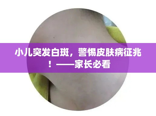 小儿突发白斑，警惕皮肤病征兆！——家长必看